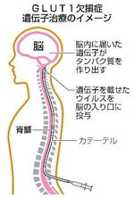 　ＧＬＵＴ１欠損症遺伝子治療のイメージ
