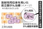 　放射性同位体を用いた前立腺がん治療（イメージ）