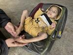 　栄養不足でやせ細った５歳の女児＝１月１１日、ガザ中部デールバラハ